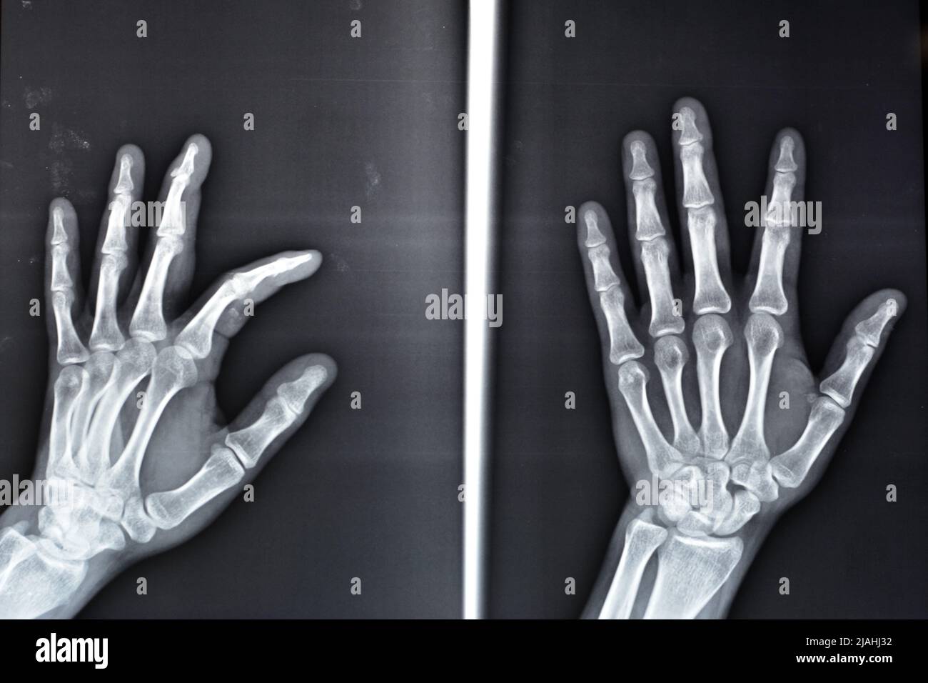 Une radiographie simple montre une base de fracture d'avulsion de la phalange distale du doigt central gauche, fracture d'un petit morceau d'os attaché à un tendon ou a Banque D'Images