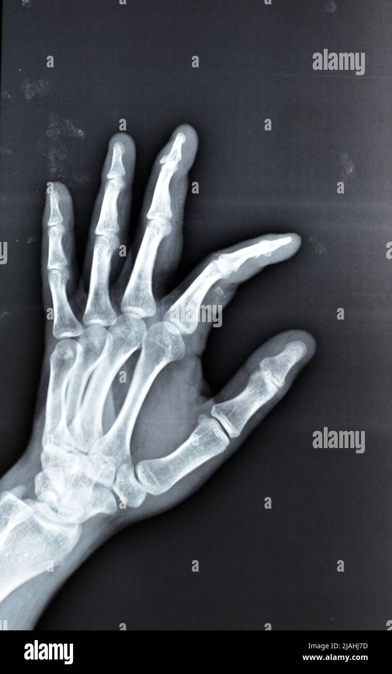Une radiographie simple montre une base de fracture d'avulsion de la phalange distale du doigt central gauche, fracture d'un petit morceau d'os attaché à un tendon ou a Banque D'Images