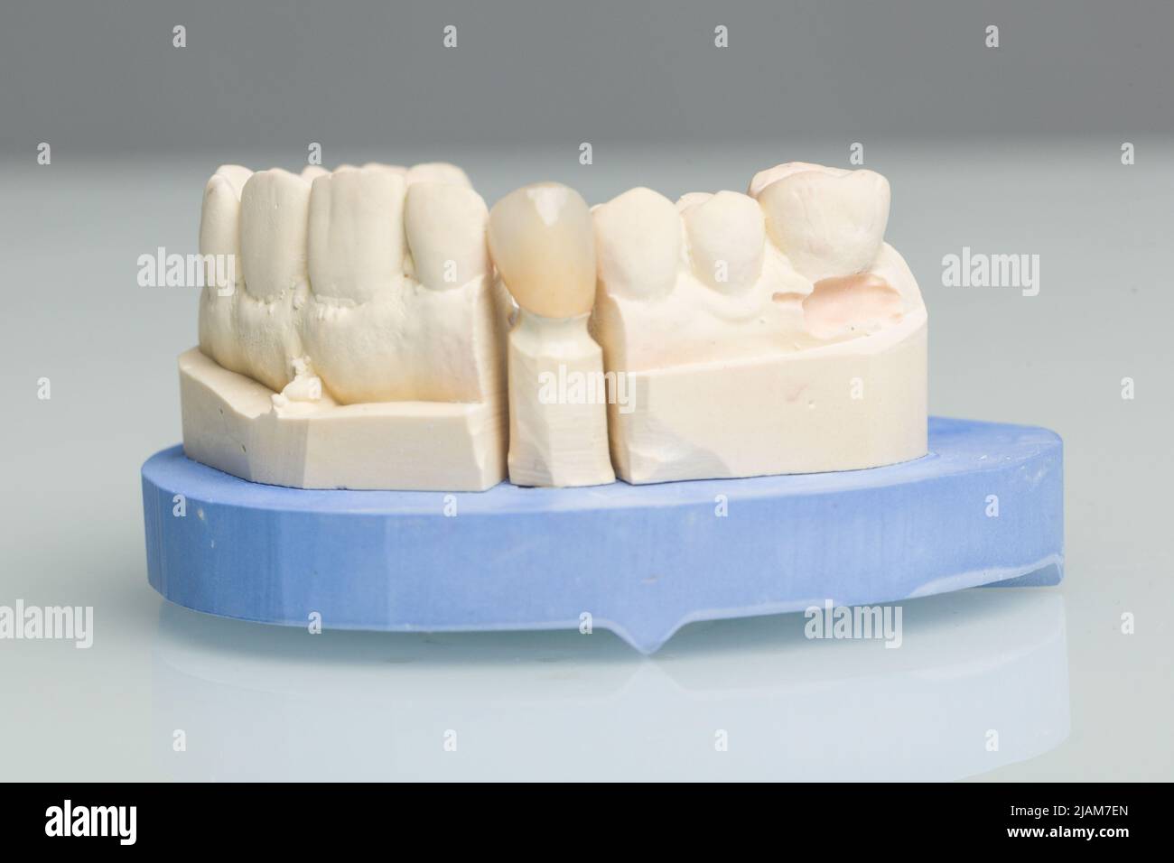 gros plan de la couronne dentaire ou de l'implant dans un laboratoire dentaire Banque D'Images