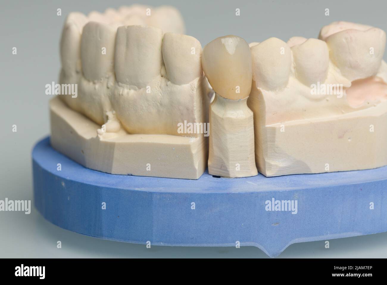 gros plan de la couronne dentaire ou de l'implant dans un laboratoire dentaire Banque D'Images