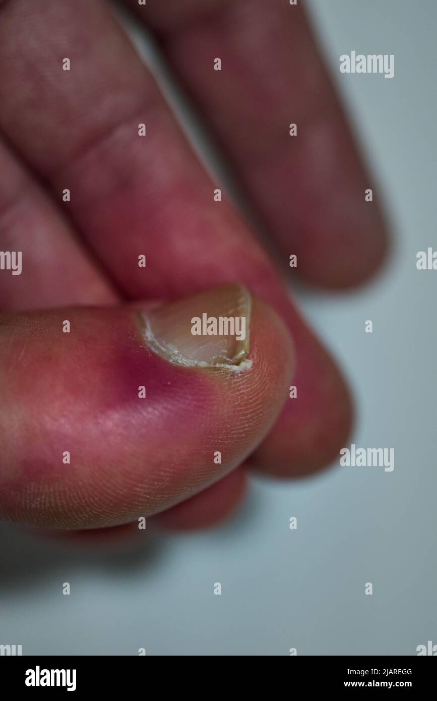 Infection à côté de l'ongle, dans le pied d'un patient Banque D'Images
