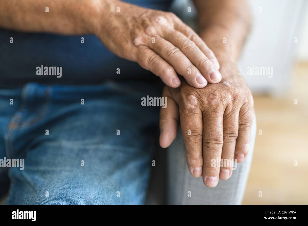 Homme âgé souffrant de psoriasis, gros plan sur les mains Banque D'Images