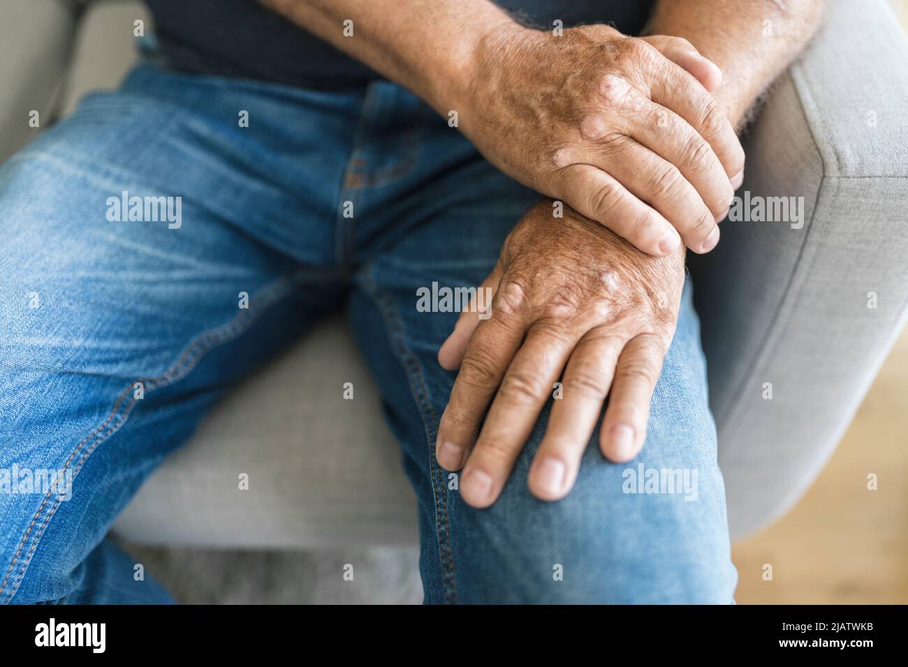Homme âgé souffrant de psoriasis, gros plan sur les mains Banque D'Images Homme âgé souffrant de psoriasis, gros plan sur les mains Banque D'Images