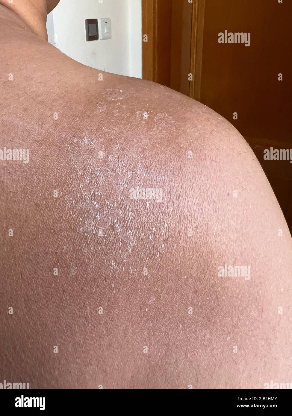 La peau sèche se décollait de l'arrière de l'épaule d'un homme asiatique après avoir brûlé le soleil. Concept de soins de la peau. Banque D'Images