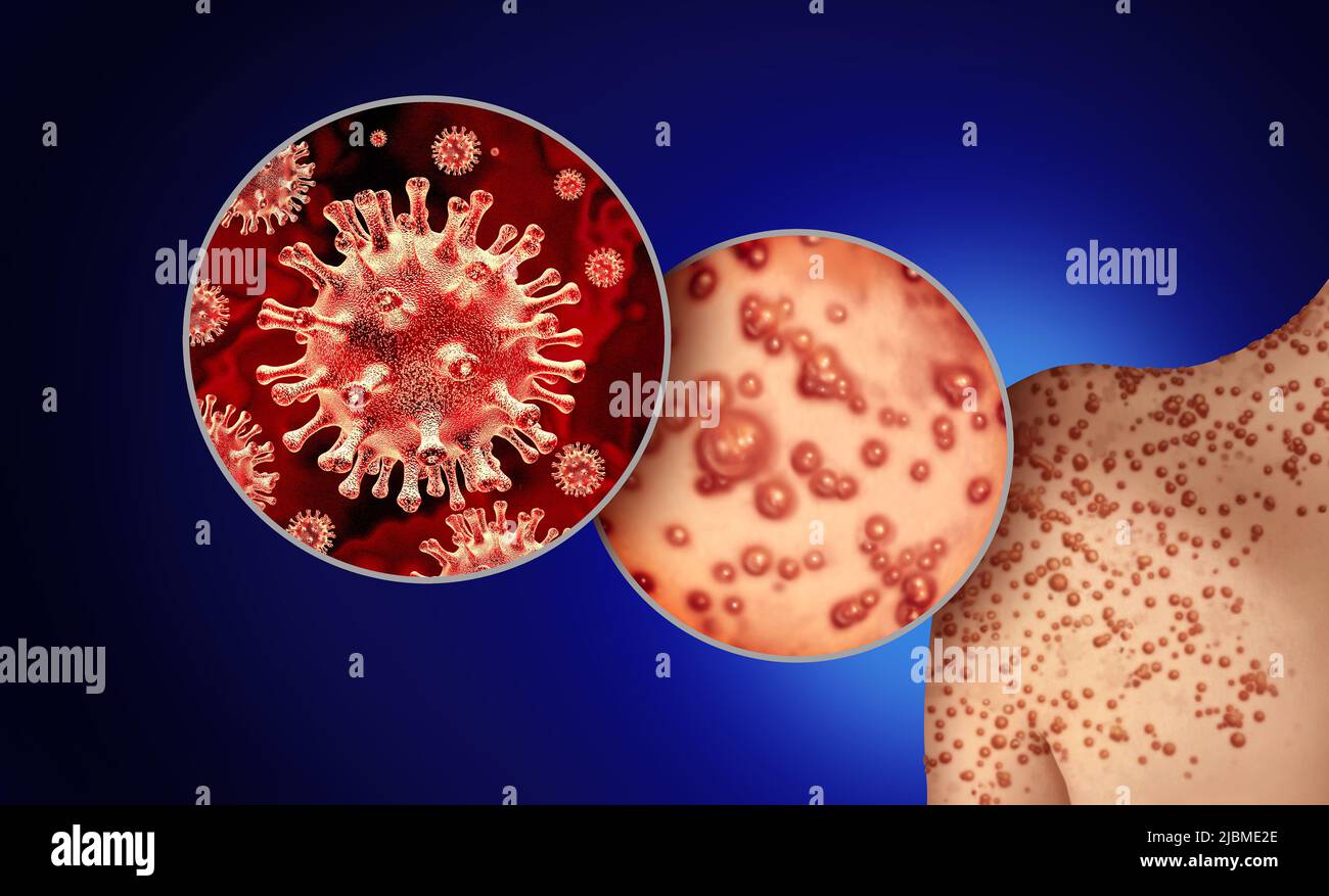 Virus de la pox de singe ou la variole du singe comme une infection contagieuse sous forme de cloques et de laisons sur la peau représentant la transmission d'une personne infectée W Banque D'Images Virus de la pox de singe ou la variole du singe comme une infection contagieuse sous forme de cloques et de laisons sur la peau représentant la transmission d'une personne infectée W Banque D'Images