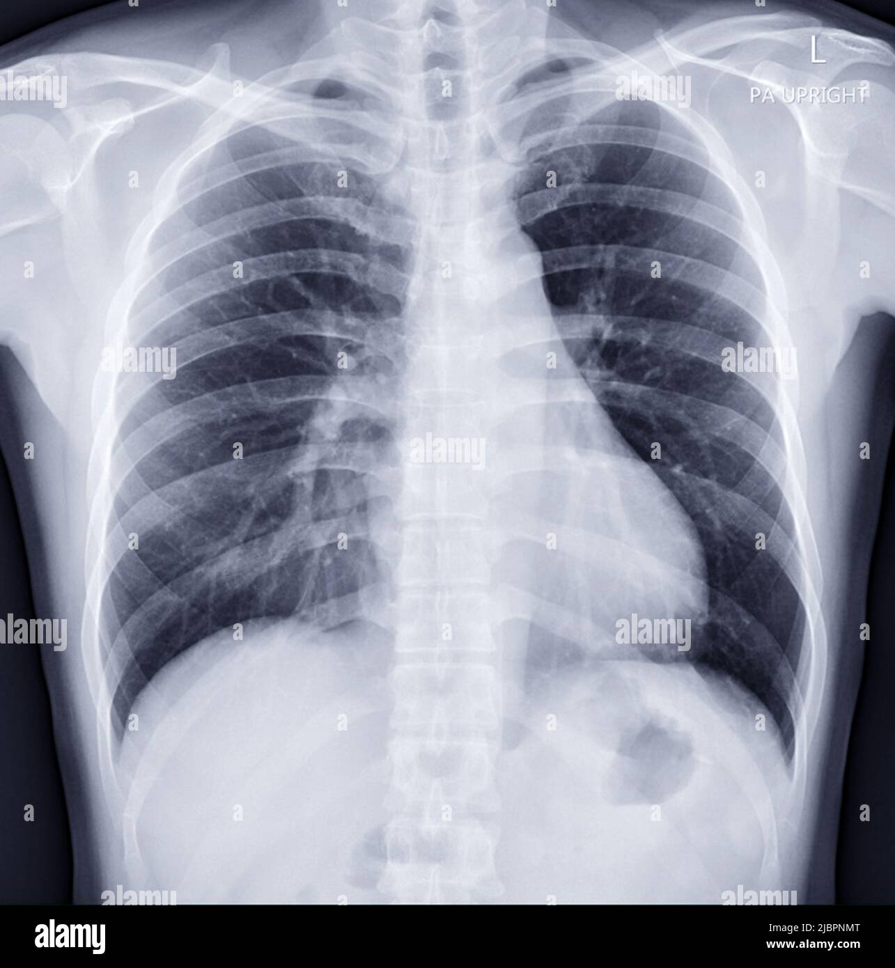 Radiographie thoracique pour le diagnostic de la tuberculose, de la tuberculose et du covid-19. Banque D'Images