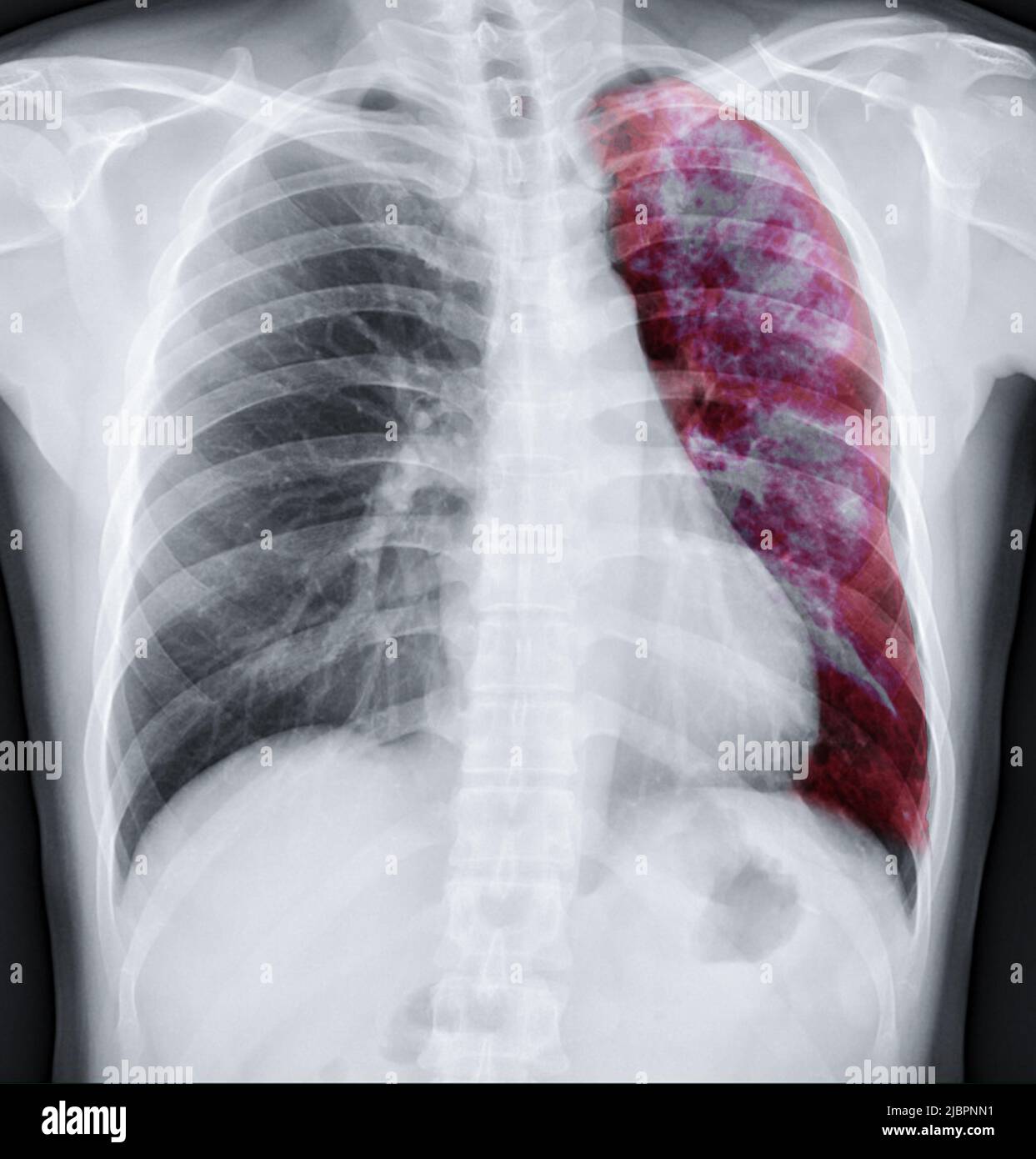 Fusion des rayons X du thorax avec l'image de rendu Lung 3D pour le diagnostic TB, TB et Covid-19 de CT-scanner 3D. Banque D'Images