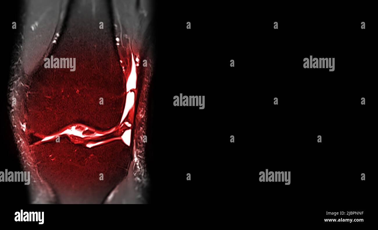 Imagerie par résonance magnétique du genou ou vue coronale du genou IRM pour détecter la déchirure ou l'entorse du ligament croisé antérieur (ACL). Banque D'Images