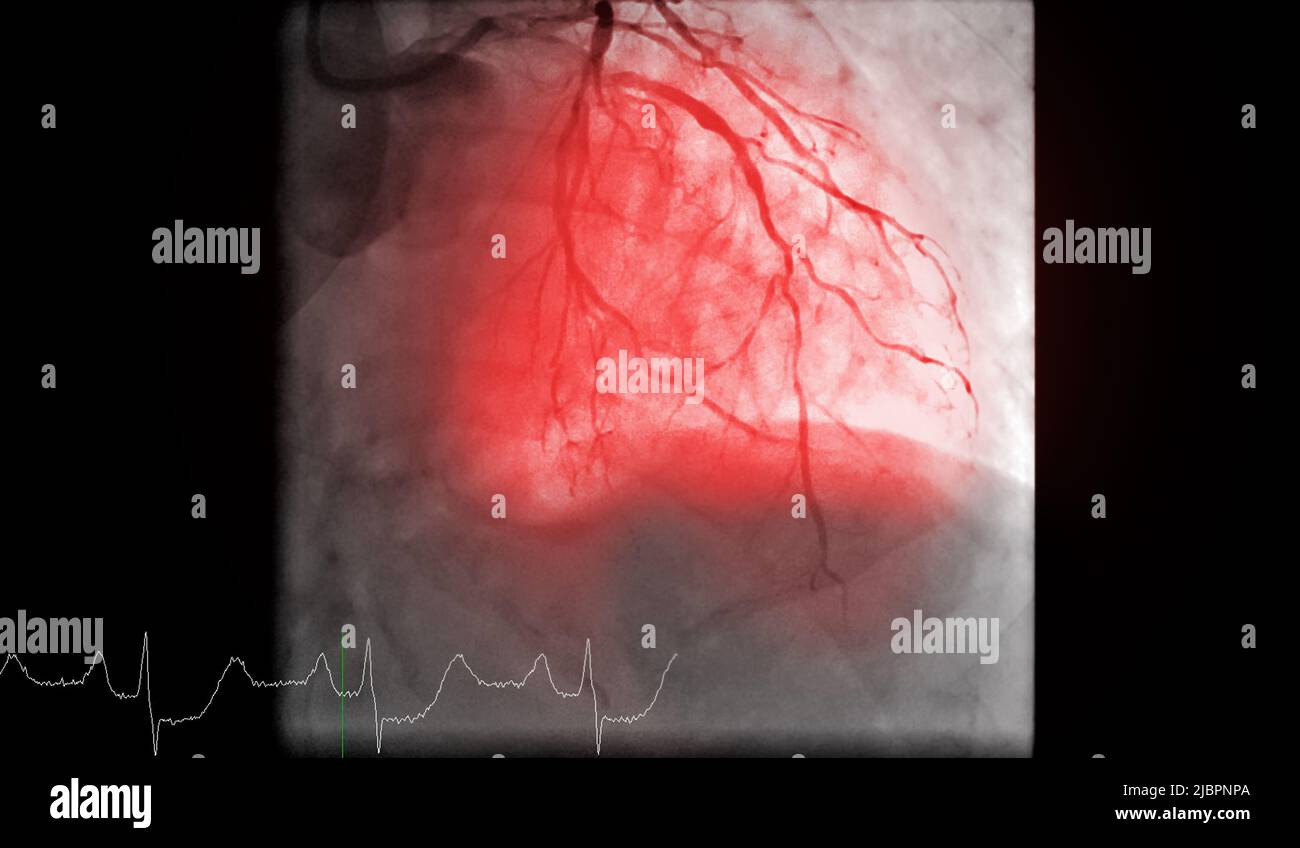 Le cathétérisme cardiaque est un test utilisé pour découvrir l'arrêt cardiaque . Banque D'Images