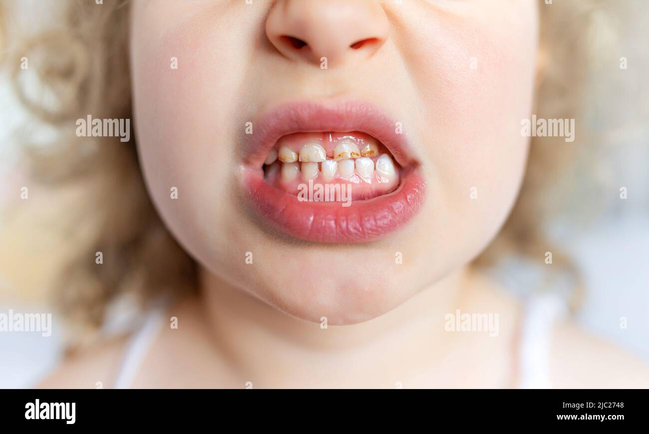 Caries et plaque dentaire sur les dents des enfants. Banque D'Images