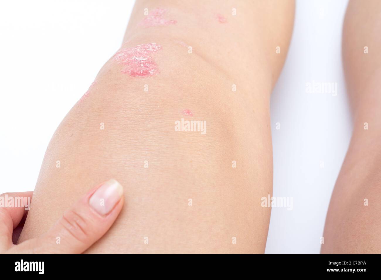 Épanchement articulaire du genou (eau sur le genou) arthrite psoriasique aiguë, arthrose, déchirure du ménisque.Excès de liquide synovial dans et autour de l'articulation du genou Banque D'Images