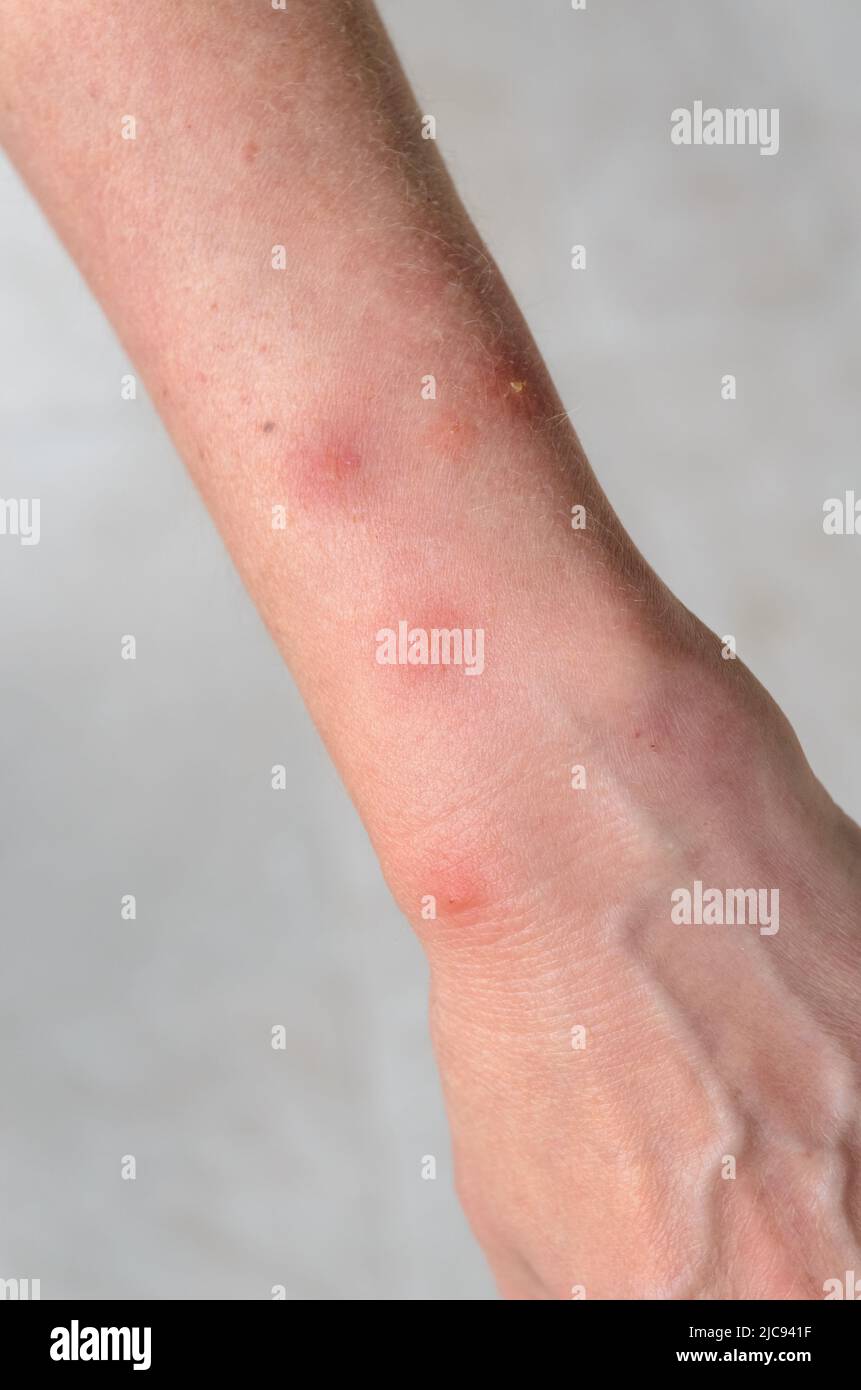Réaction allergique aux piqûres d'insectes avec des taches de gonflement  rondes sur le bras d'une femme Photo Stock - Alamy