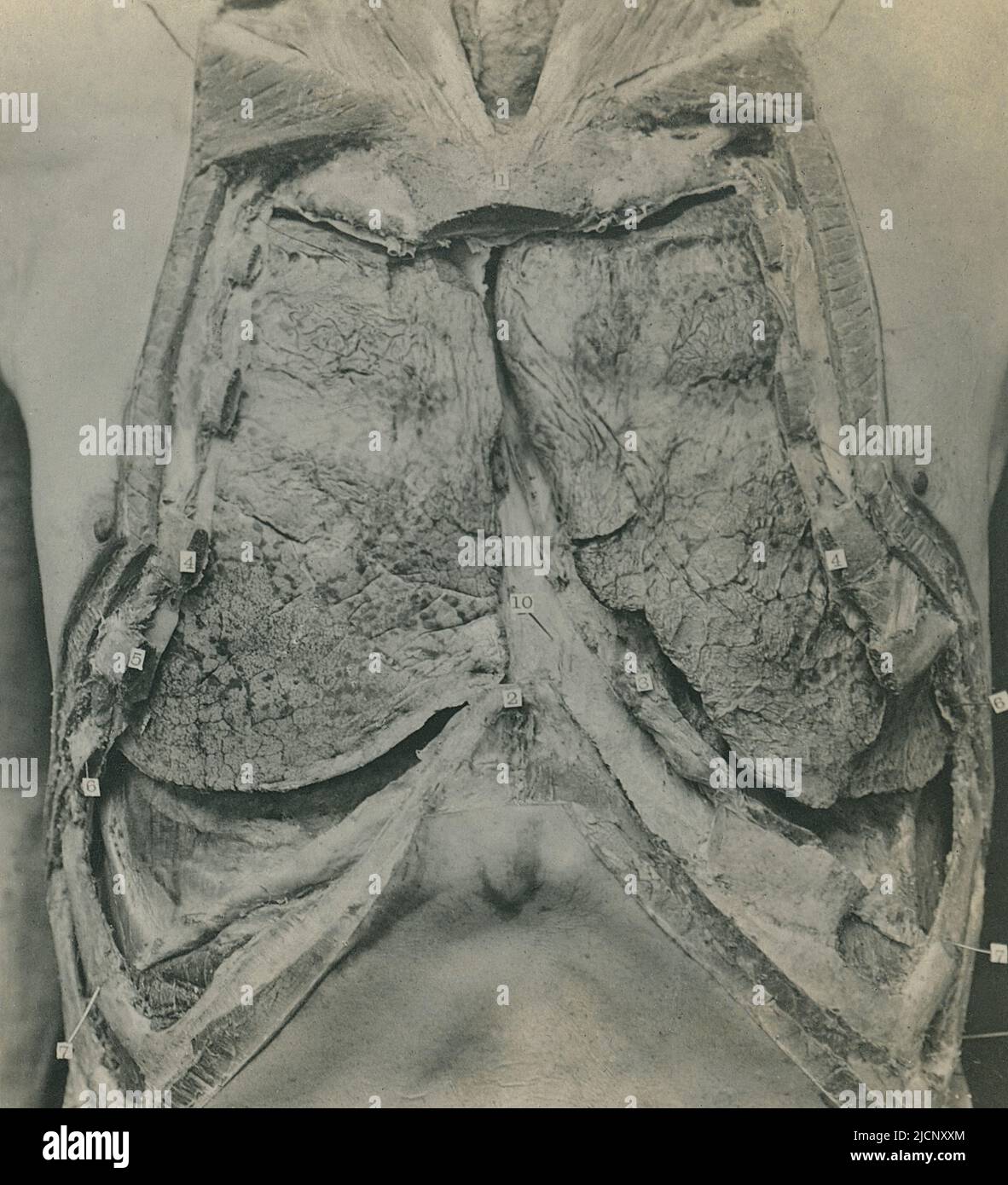 Dissection d'un cadavre montrant les poumons. Banque D'Images
