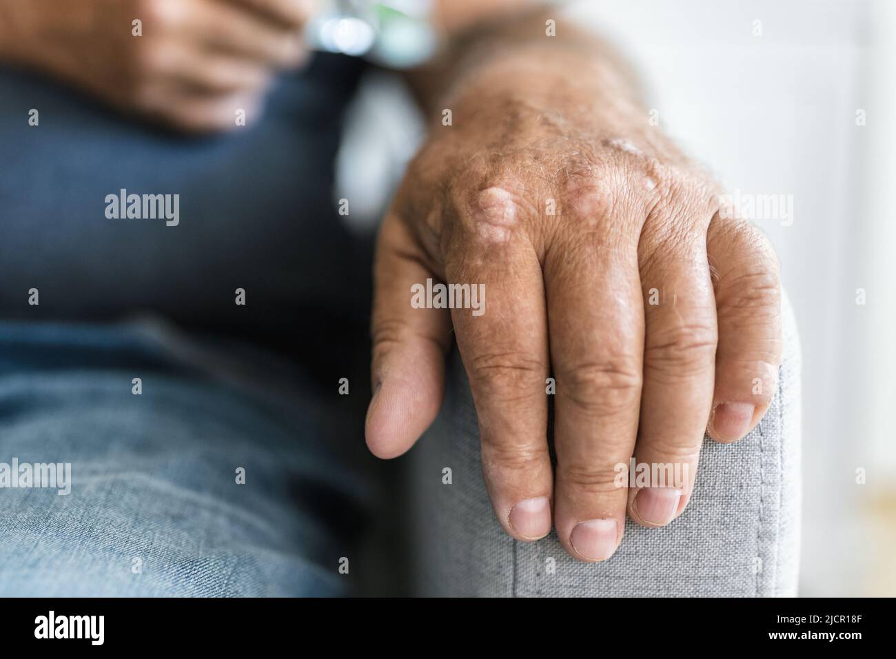 Homme âgé souffrant de psoriasis, gros plan sur les mains Banque D'Images Homme âgé souffrant de psoriasis, gros plan sur les mains Banque D'Images