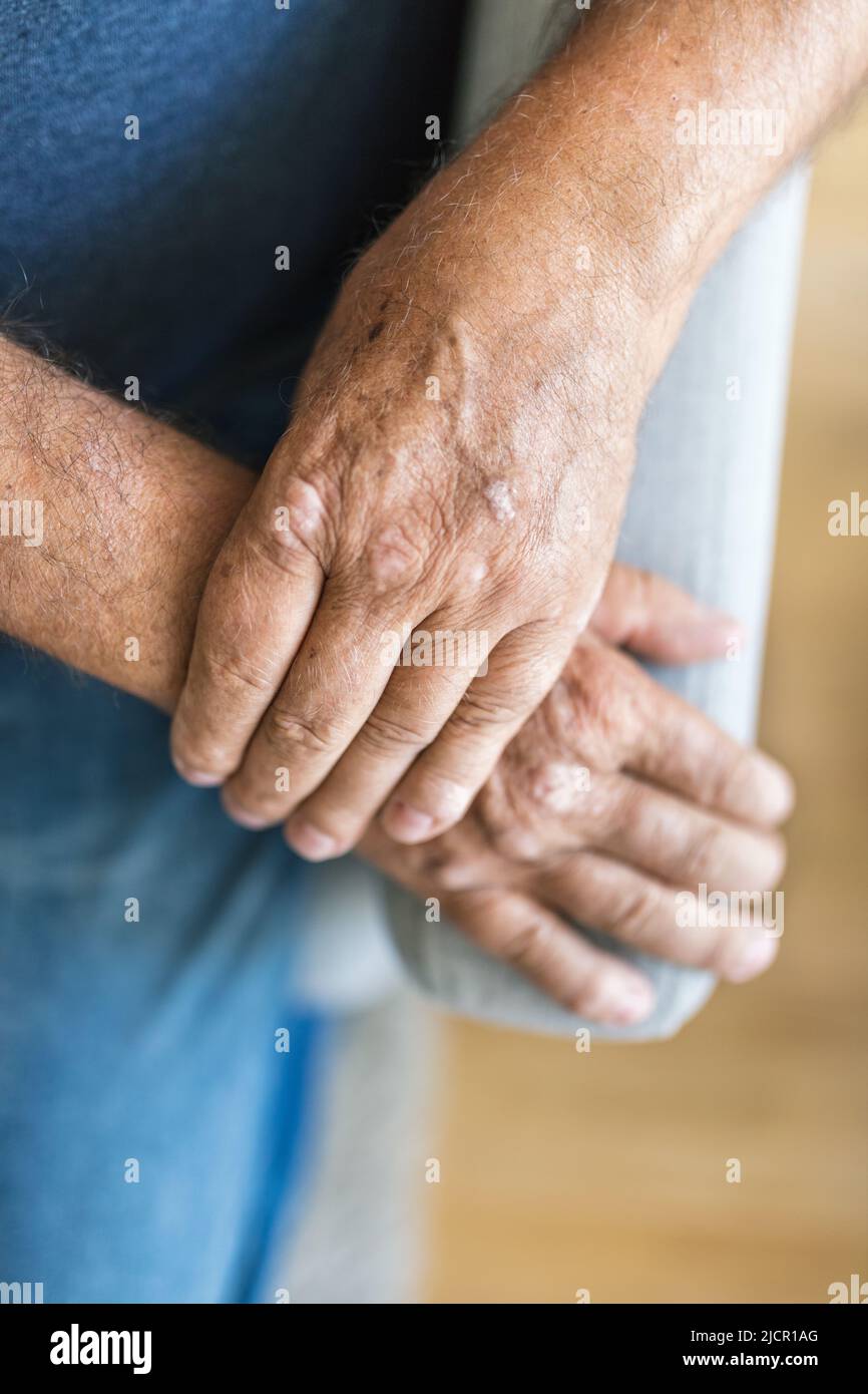 Homme âgé souffrant de psoriasis, gros plan sur les mains Banque D'Images Homme âgé souffrant de psoriasis, gros plan sur les mains Banque D'Images