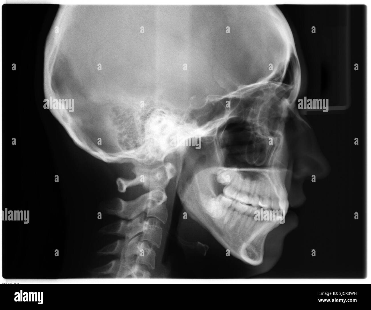 Image radiographique de la vue latérale du crâne (latérale, LAT). Crâne, mâchoire et cou humains sur fond noir. Tête de femme. Banque D'Images Image radiographique de la vue latérale du crâne (latérale, LAT). Crâne, mâchoire et cou humains sur fond noir. Tête de femme. Banque D'Images