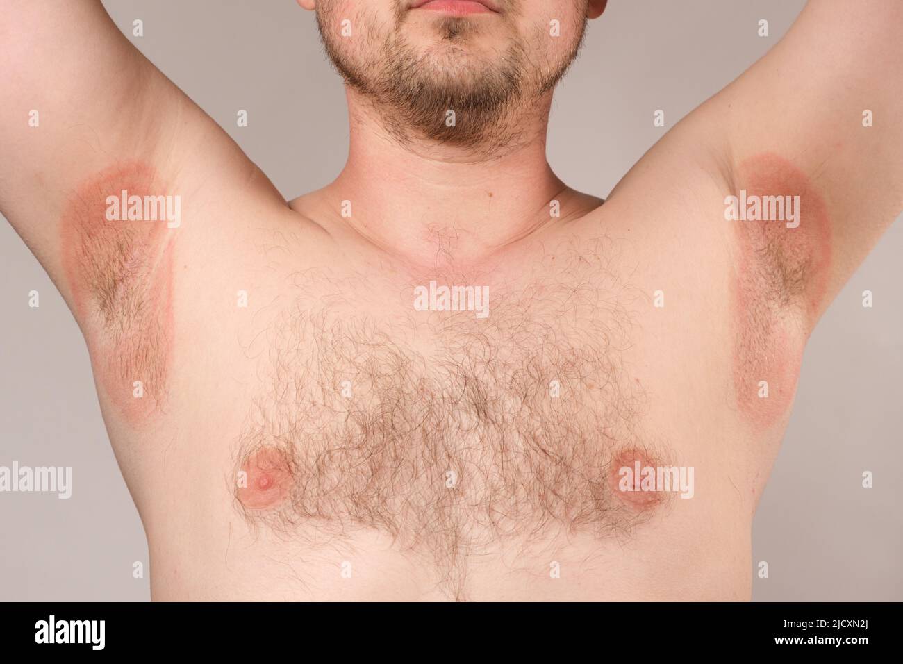 Rougeur des aisselles chez un homme - inflammation ou chaleur piqueuse, taches rouges des aisselles. Banque D'Images