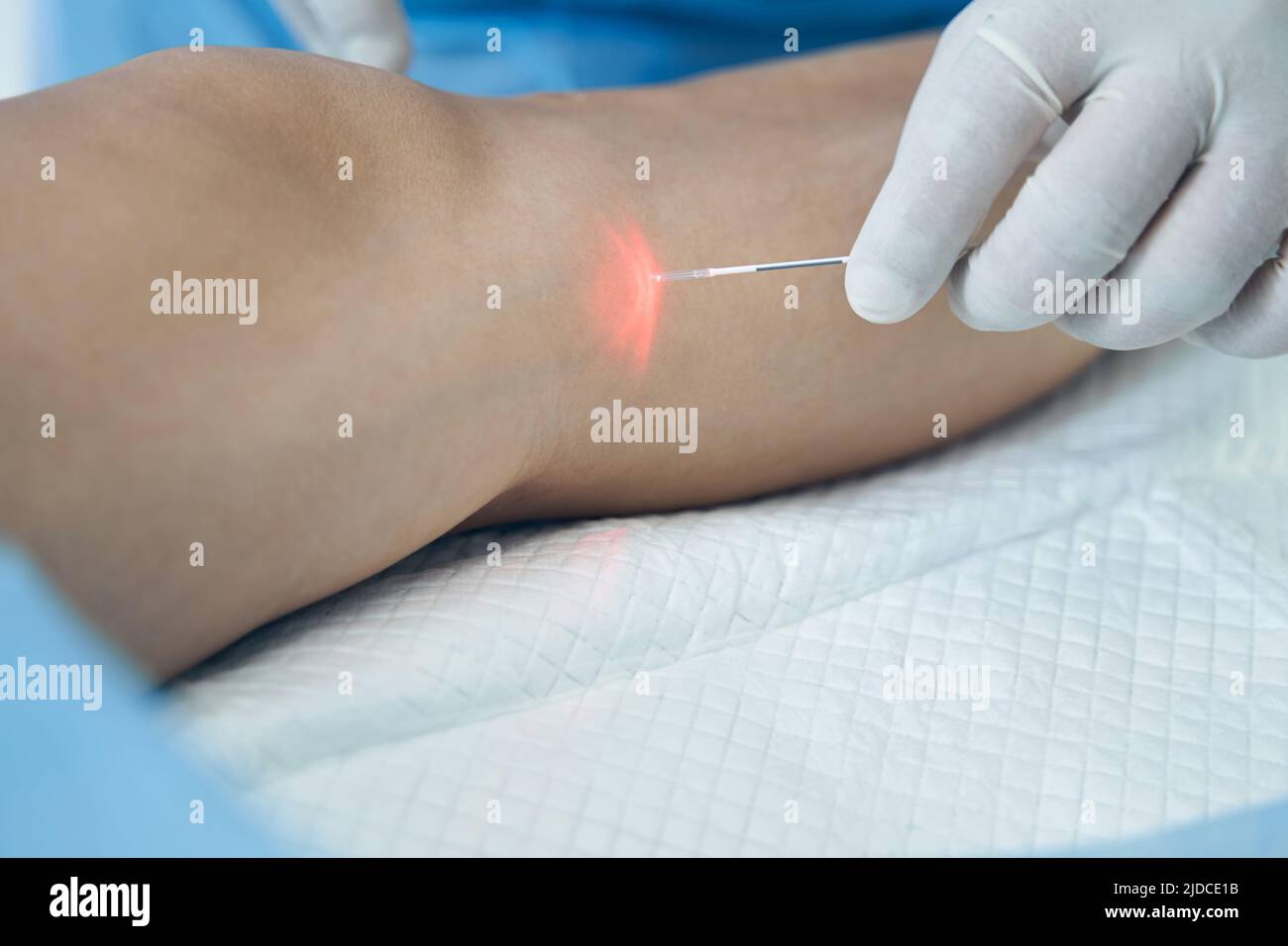 Traitement au laser endoveineux de la veine de la jambe à l'hôpital Banque D'Images