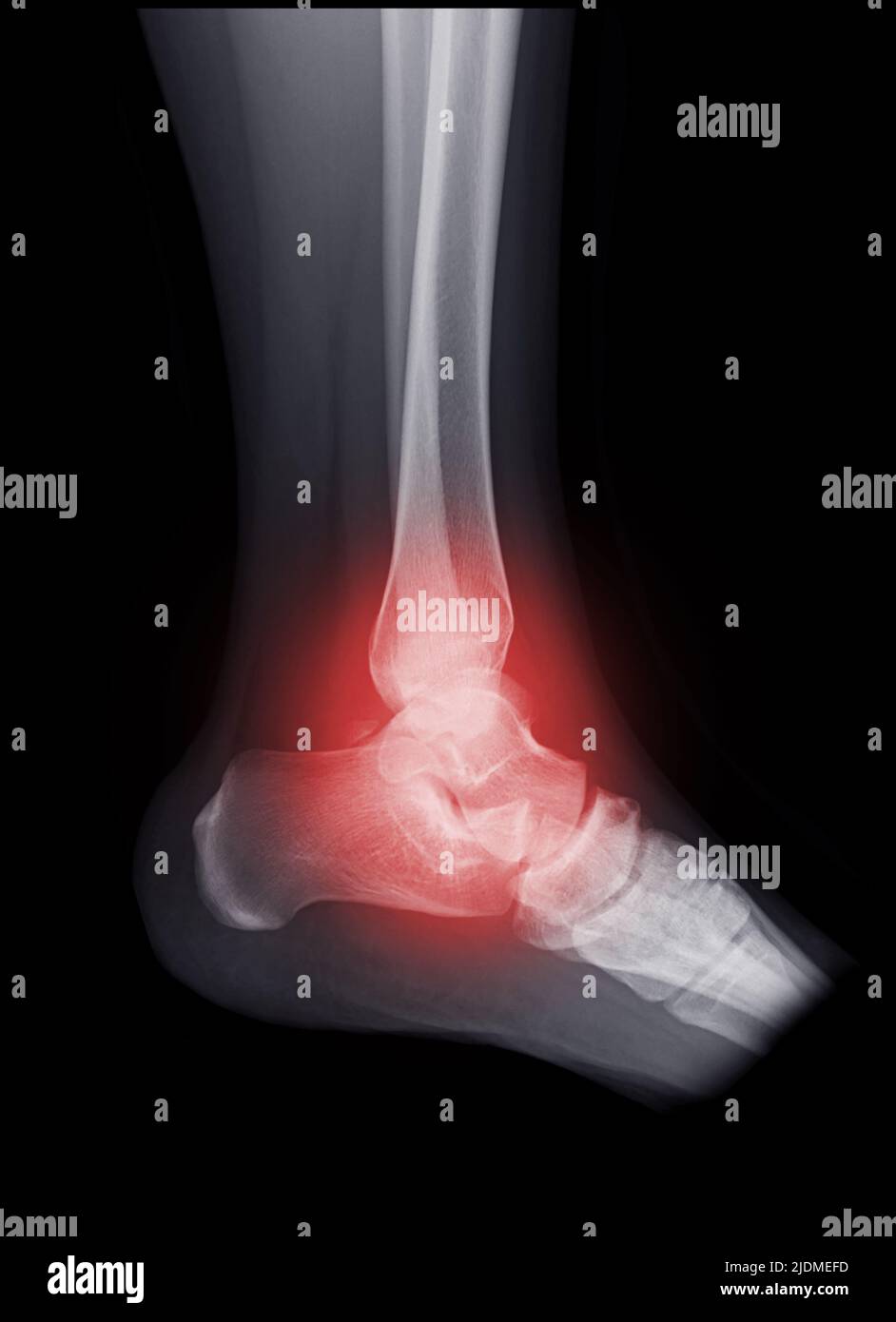 Image radiographique de l'articulation de la cheville pour le diagnostic de fracture du tibia et de l'os du péroné. Banque D'Images