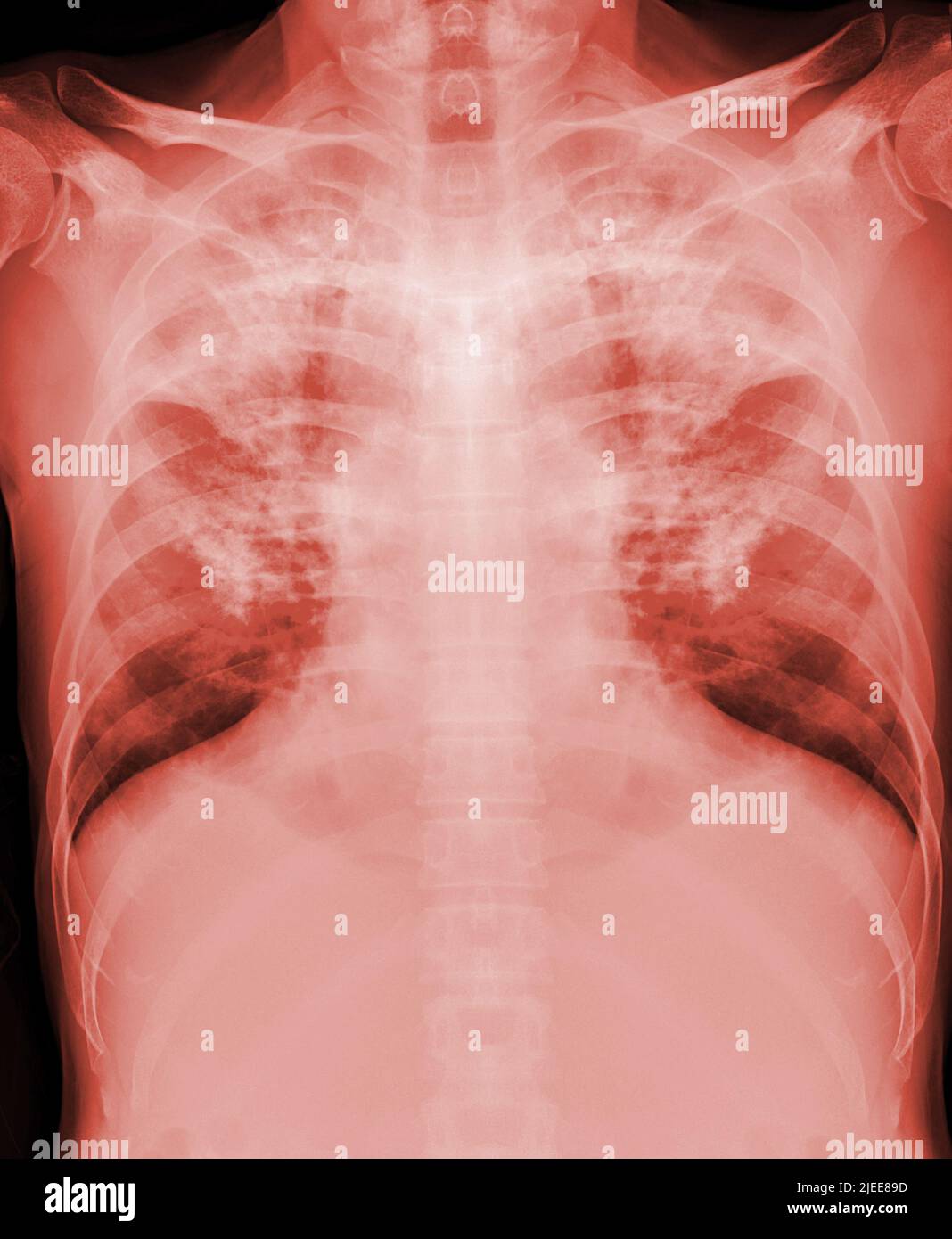 Image de radiographie thoracique showign TB,tuberculosis ou Covid-19 . Banque D'Images