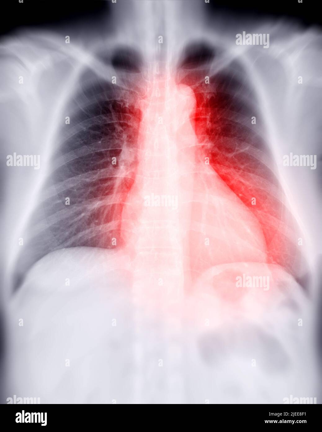 Radiographie thoracique pour le dépistage de la tuberculose, de la tuberculose et du covid-19. Banque D'Images