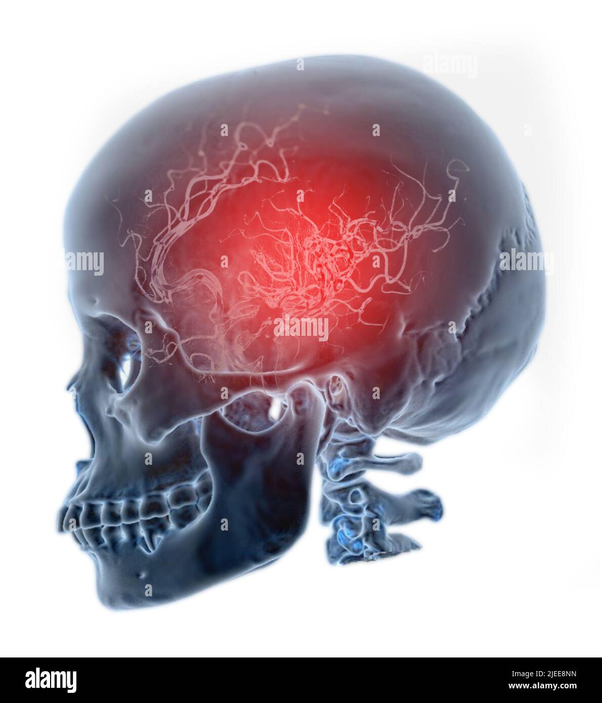 Image de rendu du crâne 3D de la fusion humaine avec l'angiogramme cérébral isolé sur fond blanc. Banque D'Images