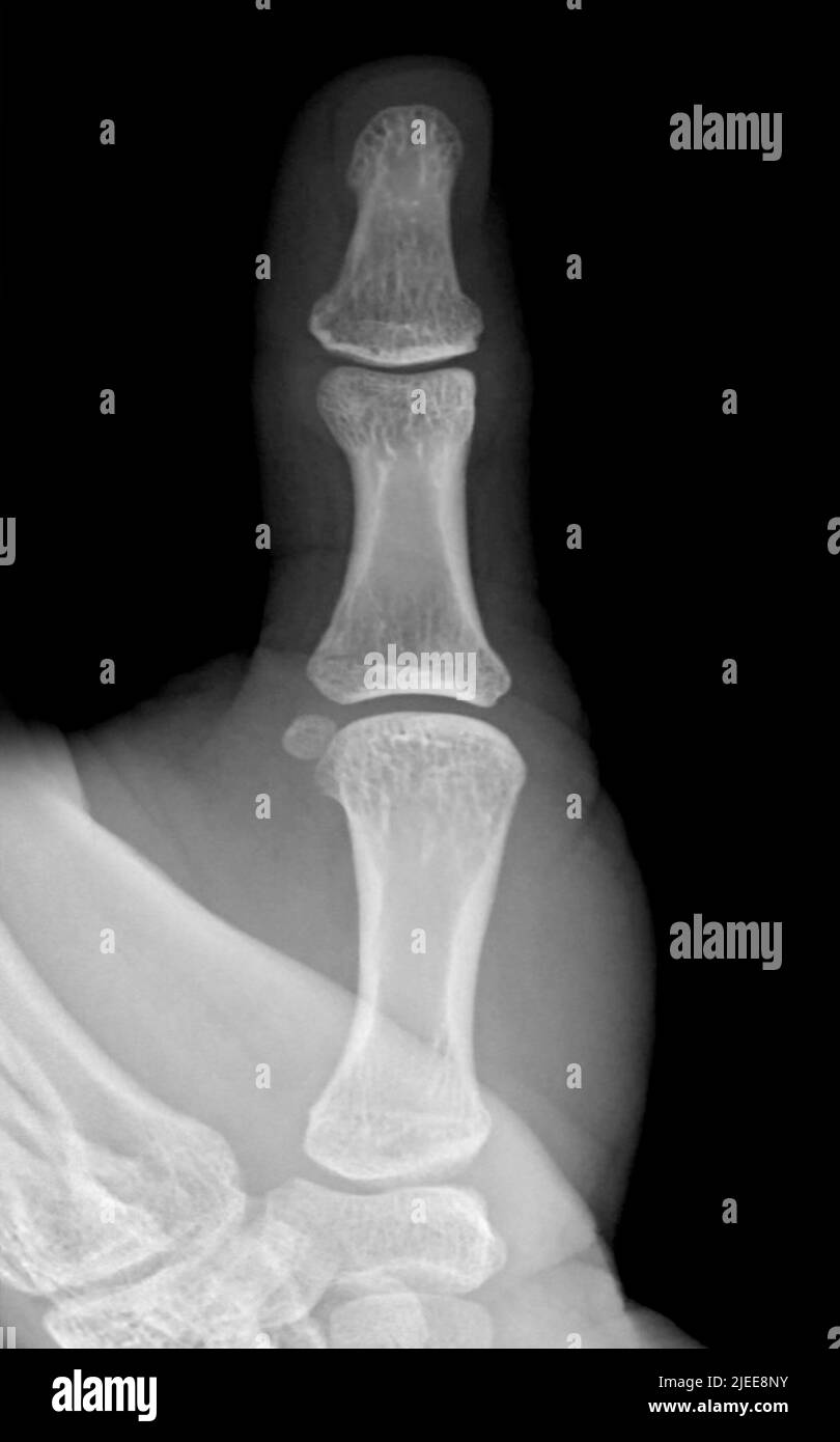 image x-raiy du pouce. Banque D'Images