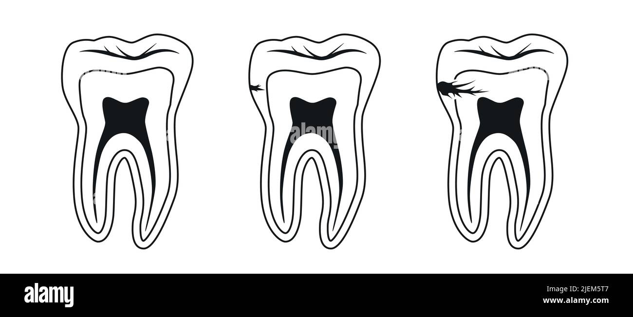 Profil de dent avec icônes vectorielles de caries Illustration de Vecteur