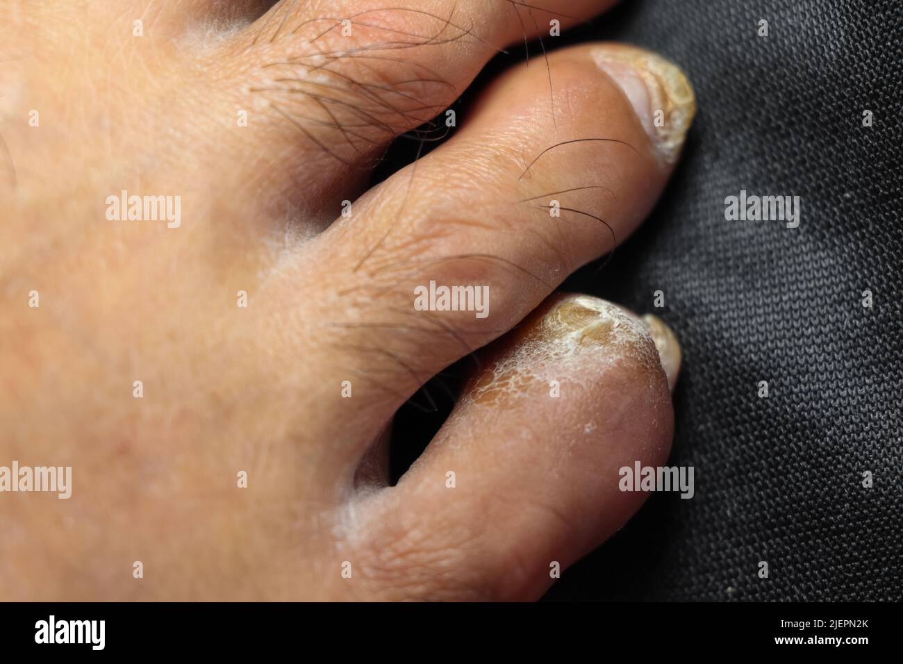 Les produits chimiques dangereux utilisés dans l'industrie corrodent l'orteil Banque D'Images