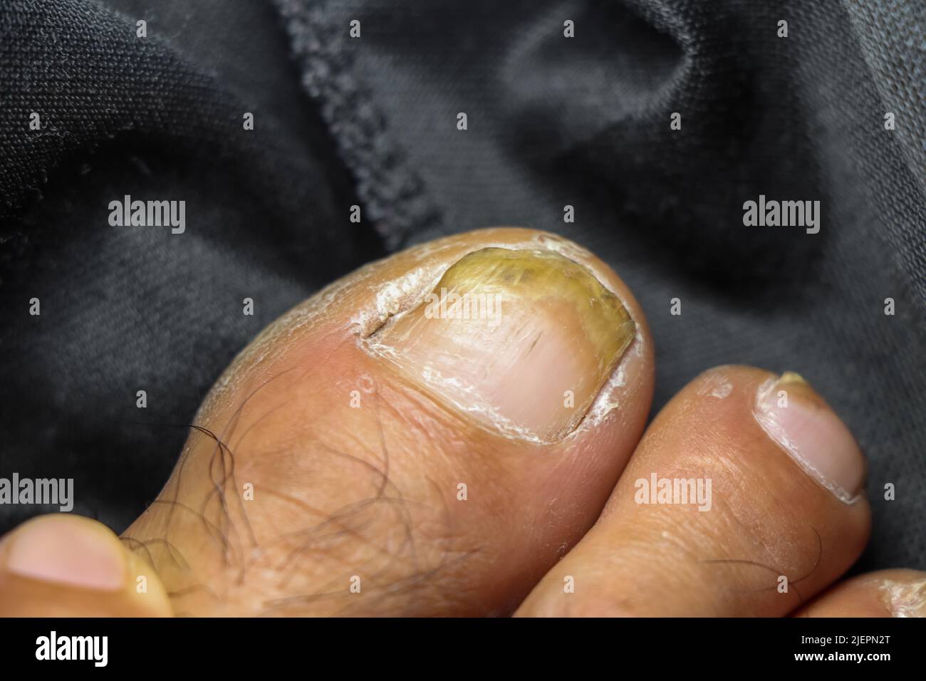 Les produits chimiques dangereux utilisés dans l'industrie corrodent l'orteil Banque D'Images