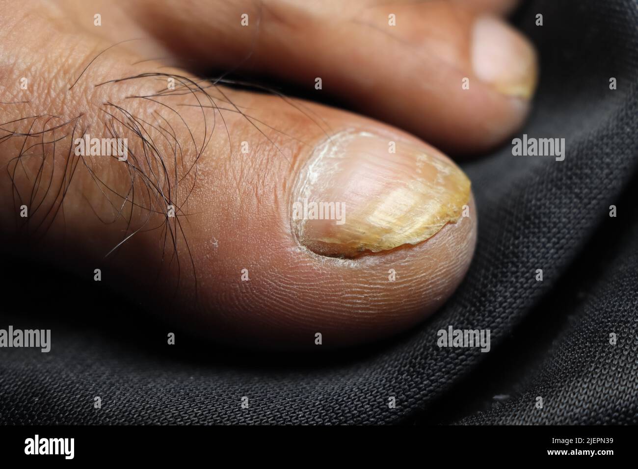 Les produits chimiques dangereux utilisés dans l'industrie corrodent l'orteil Banque D'Images