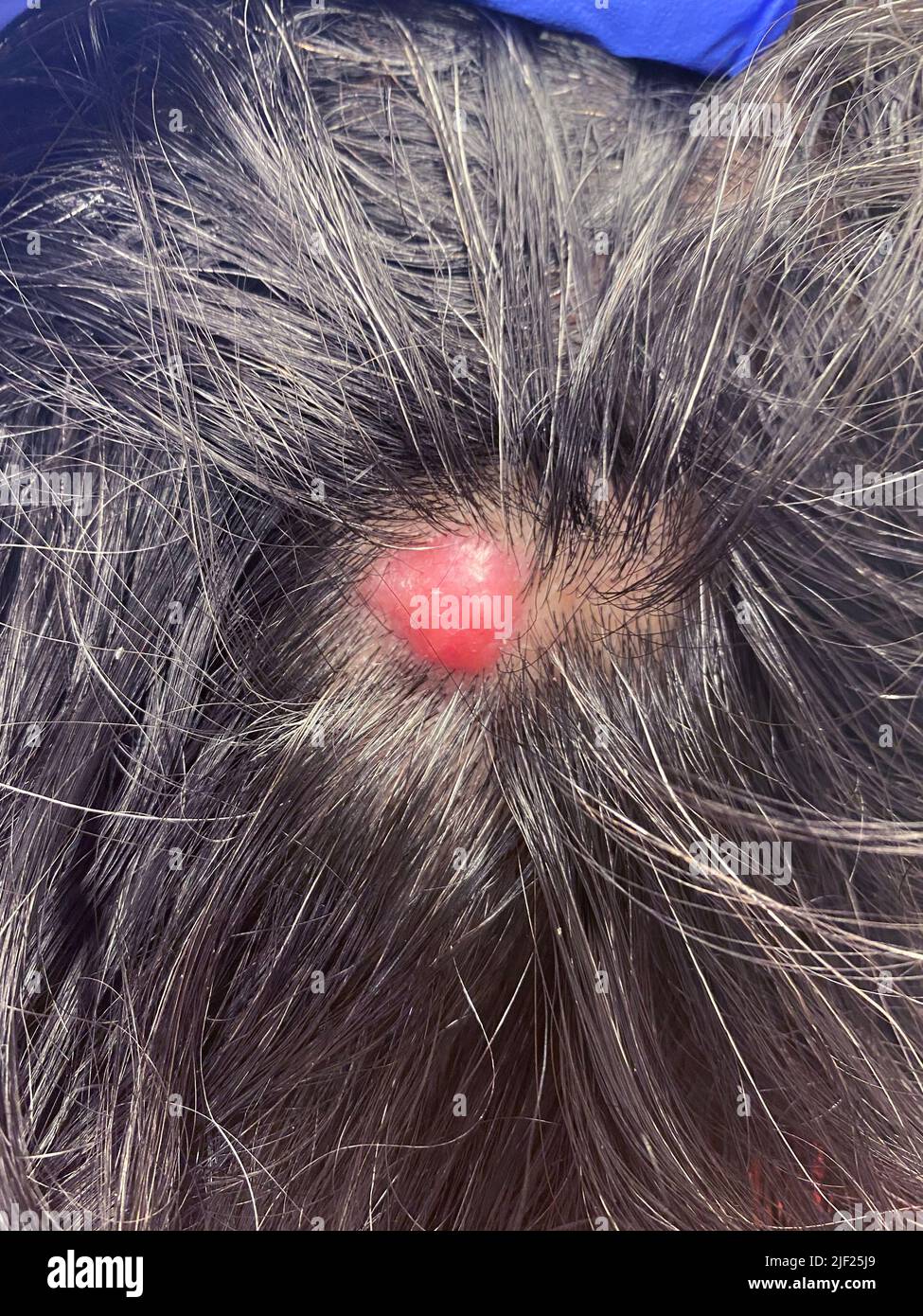 Adénocarcinome métastatique sur le cuir chevelu d'un patient. Il s'agit d'un cancer secondaire