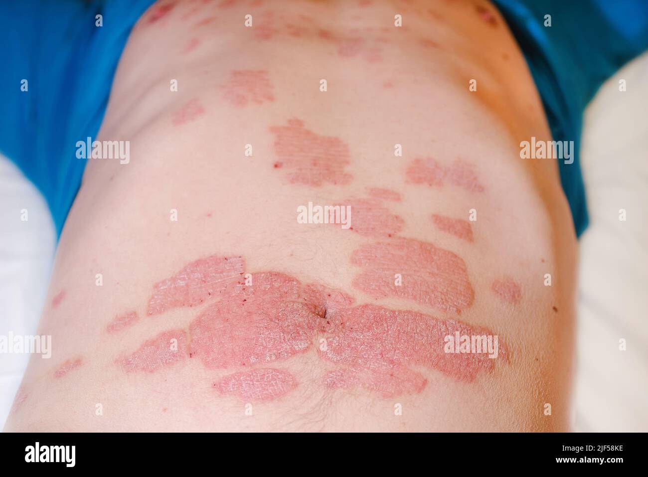 Grande éruption cutanée rouge enflammée et squameuse sur l'estomac. Psoriasis aigu sur l'estomac chez un homme, rougeur sévère sur la peau, une maladie auto-immune incurable Banque D'Images