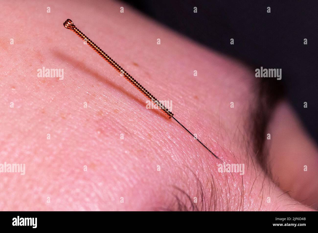 Un portrait macro d'une petite aiguille d'acupuncture qui colle dans la tête  avant du visage d'une personne entre les sourcils, pour soulager le stress,  guérir la douleur ou ano Photo Stock -