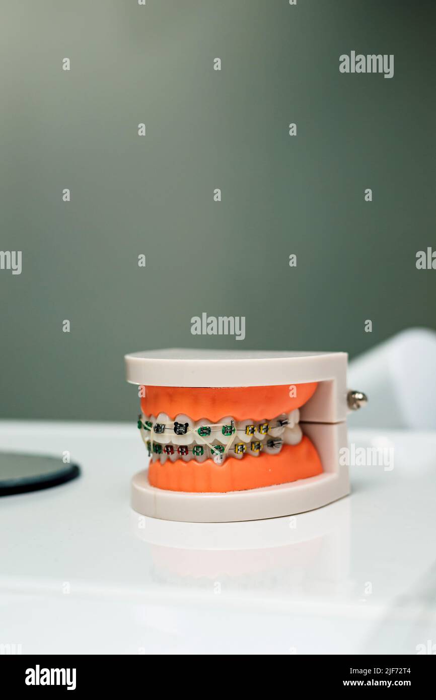 Un modèle de la mâchoire avec des bretelles repose sur la table à l'orthodontiste Banque D'Images
