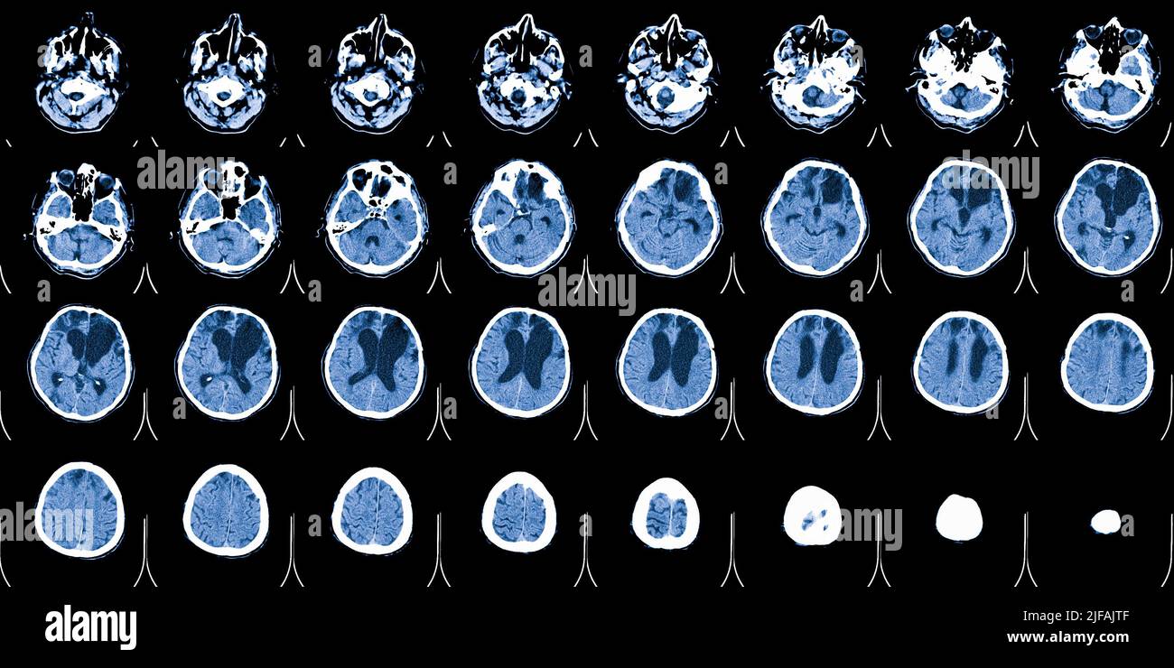 IRM du cerveau. Acquisition d'imagerie par résonance magnétique. Médecine, science et éducation formation CT Banque D'Images