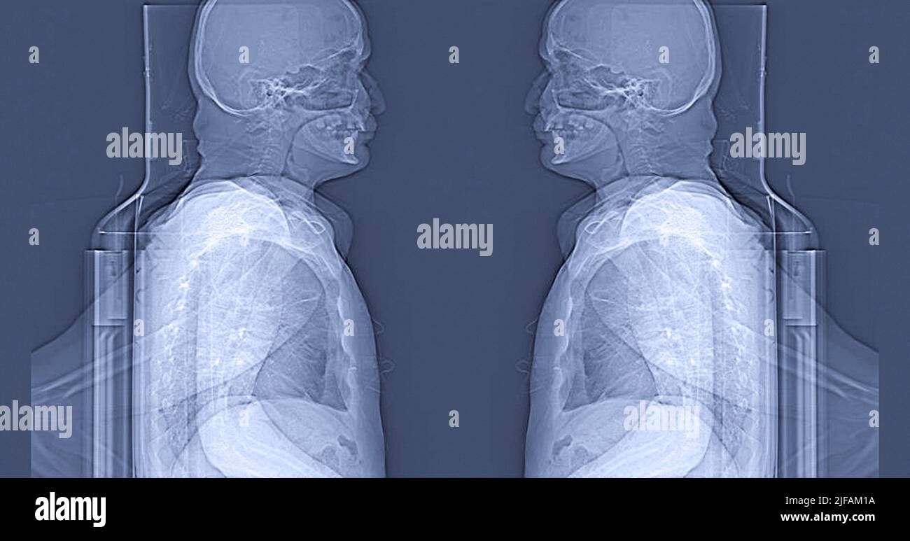 Tête humaine sur CT scan. Médecine, science et éducation formation cerveau irm. Imagerie par résonance magnétique Banque D'Images