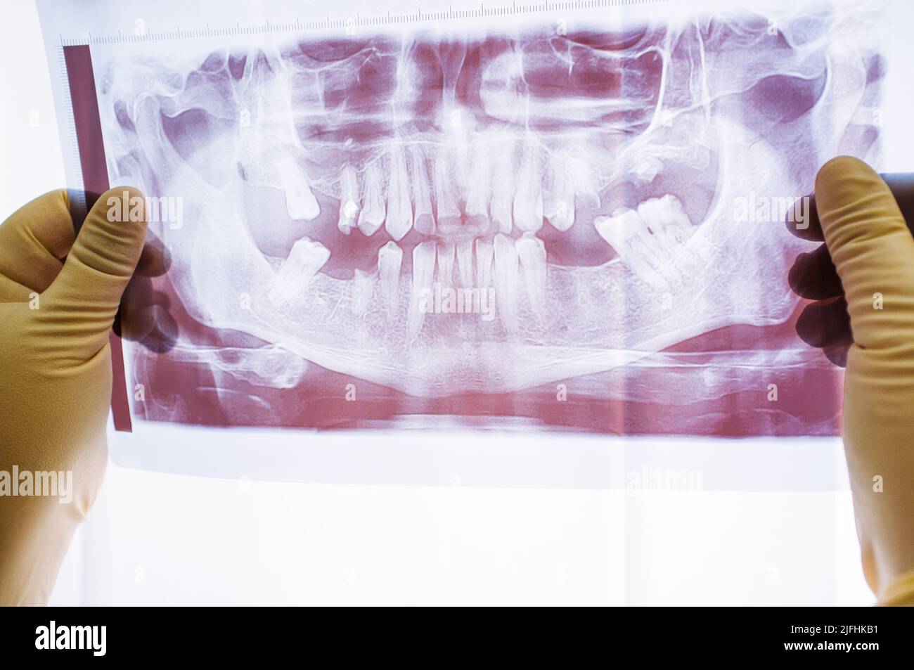 Radiographie dentaire avec problèmes de parodontite Banque D'Images