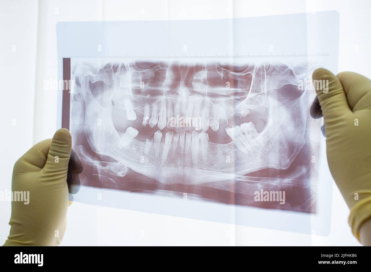 Vue rapprochée des mâchoires à rayons X panoramiques dentaires Banque D'Images