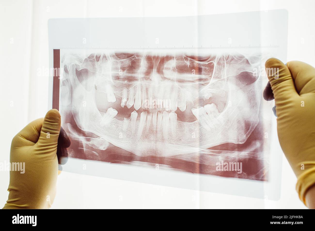 Balayage panoramique de la mutation dentaire en gros plan Banque D'Images