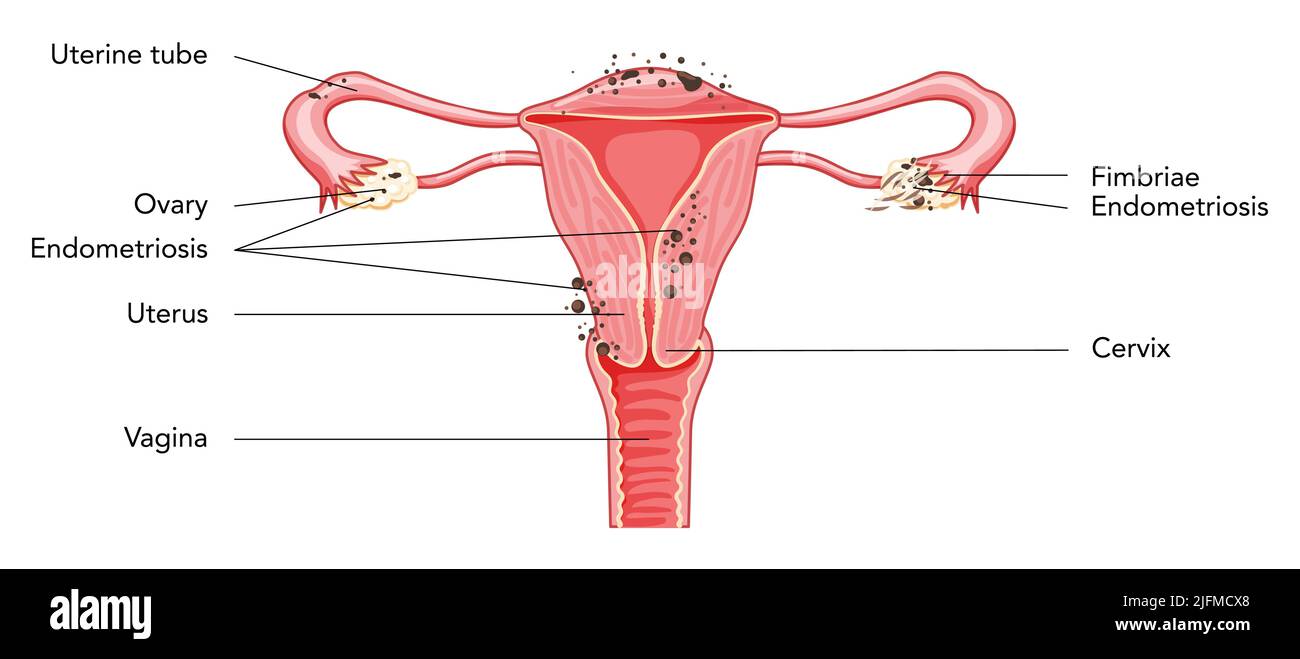Schéma de l'utérus du système reproducteur féminin avec inscriptions en  texte latin. Vue de face dans une coupe. Schéma de localisation des organes  internes de l'anatomie humaine, col de l'utérus, ovaire, trompe