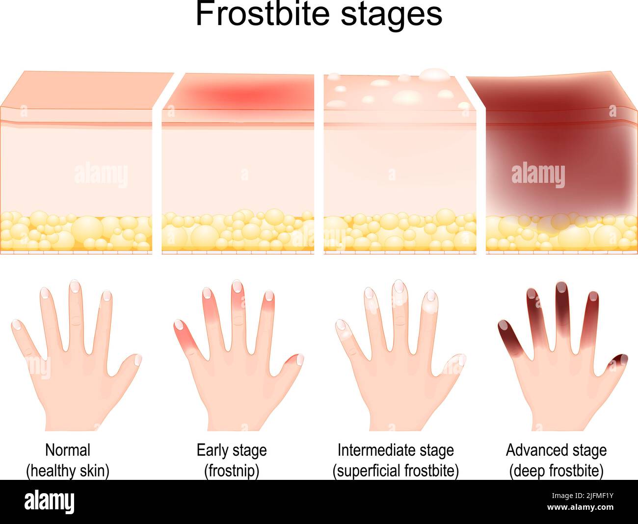 Phases de gelure. Les symptômes en cours. Comparaison des lésions cutanées après le gel. Les doigts humains sur une paume après un stade précoce ou une grenouille, Illustration de Vecteur