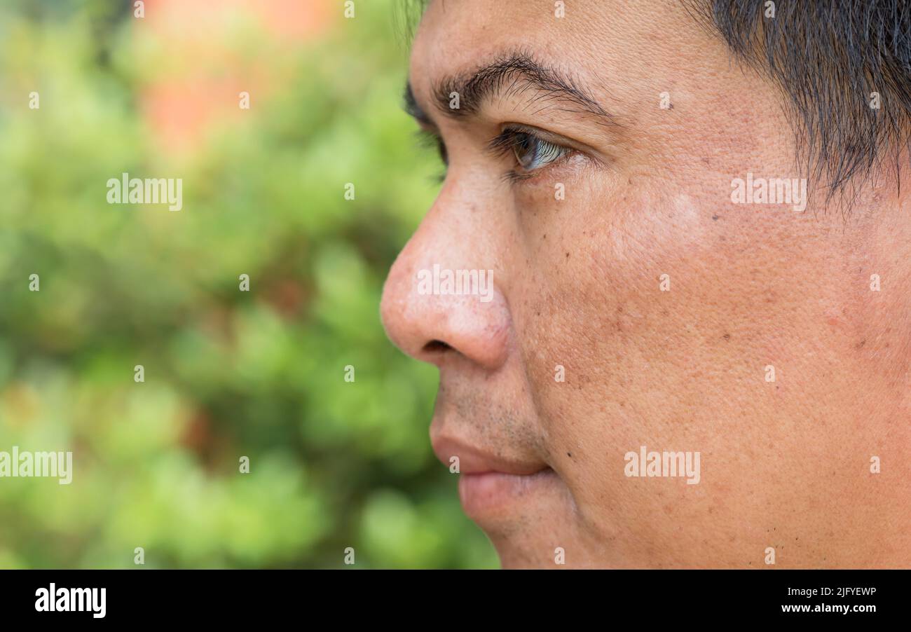 Gros plan visage peau de l'homme asiatique pour montrer beaucoup de problèmes de peau. Concept de soin de la peau pour hommes avec un espace vert flou Banque D'Images