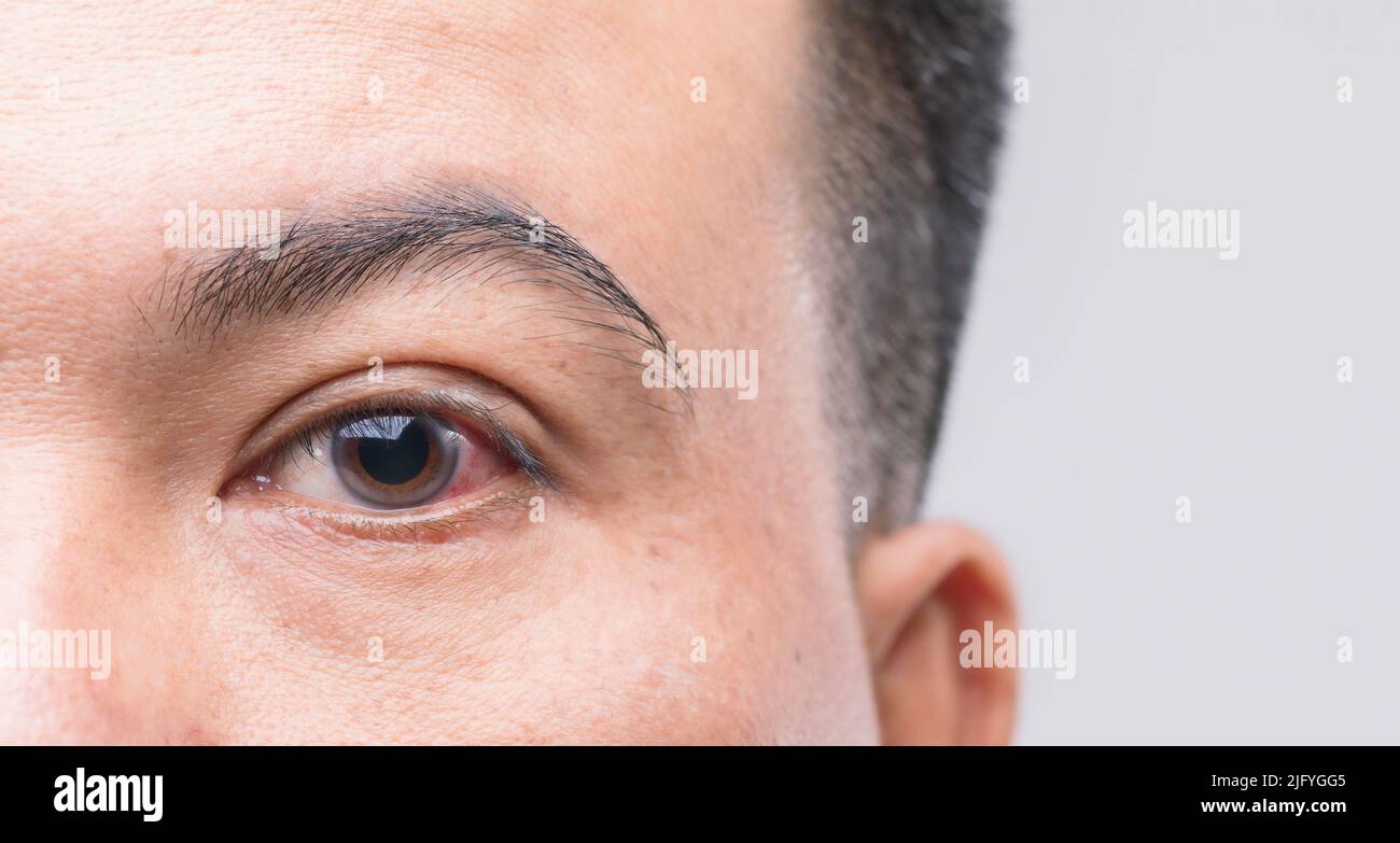 Notion : Macro yeux rouges de l'homme, conjonctivite ou après avoir pris de la poussière Banque D'Images