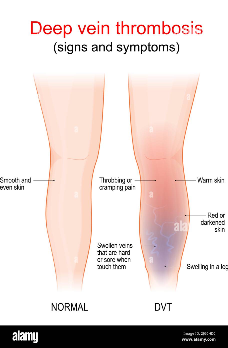 la thrombose veineuse profonde est un caillot de sang dans une veine, habituellement la jambe. Une jambe et une jambe saines avec un TVP. Signe et symptômes de thrombophlébite. Vaisseau sanguin Illustration de Vecteur