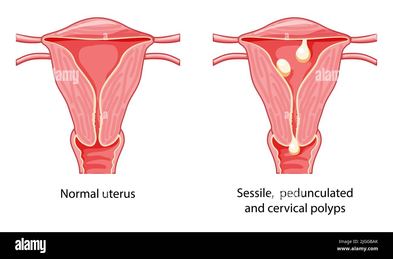 Ensemble de polypes dans l'utérus système reproductif féminin dans les ...