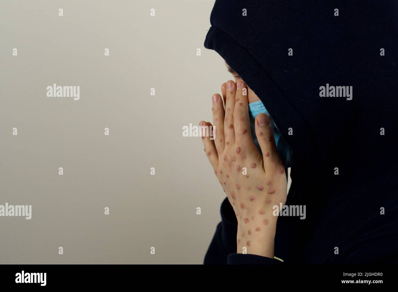 Femme dans le capot avec une éruption vésiante sur les mains Banque D'Images