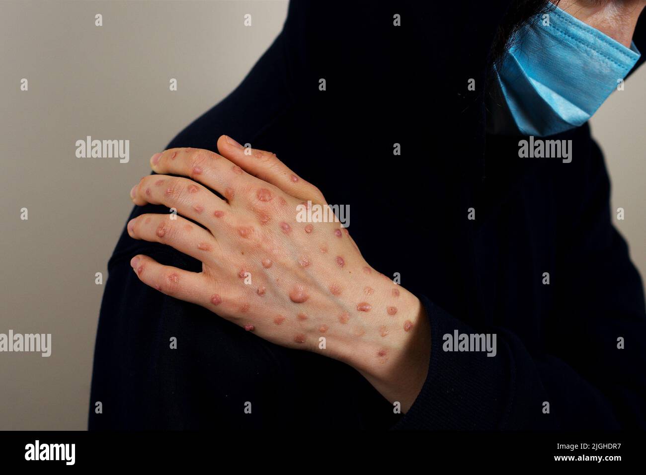 La main de la femme avec une éruption de la variole du singe sur l'épaule Banque D'Images