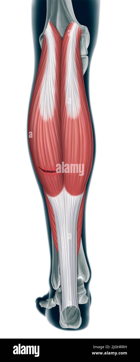 Déchirure du muscle du mollet (déchirure du muscle du mollet) Banque D'Images