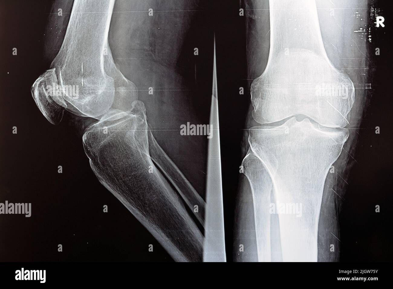 Le rayon X simple du genou droit montre une arthrose apparente de l'articulation selon le système Kellgren et Lawrence pour la classification de l'arthrose avec Banque D'Images